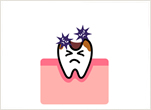 歯ぐきが腫れる原因：顎骨骨髄炎